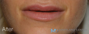 Injectables/Filler Before and After Pictures Baltimore, MD