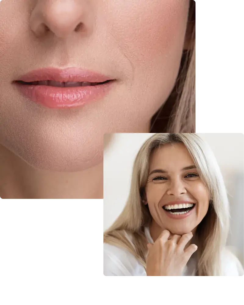 lip-lift-augmentation-transfer-injections-66c8d2f9eadb4