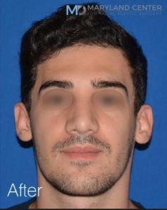 Rhinoplasty Before and After photos in Maryland