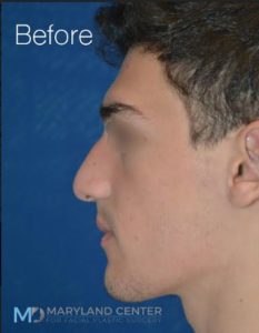 Rhinoplasty Before and After photos in Maryland