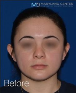 Otoplasty before and after photos