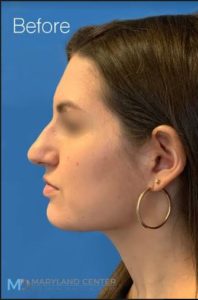 Rhinoplasty Before and After photos in Baltimore Maryland