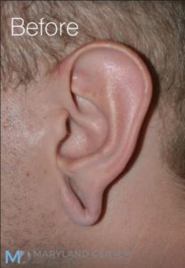 Earlobe Repair Before & After photos in Baltimore Maryland