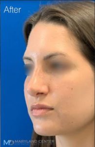 Rhinoplasty Before and After photos in Baltimore Maryland