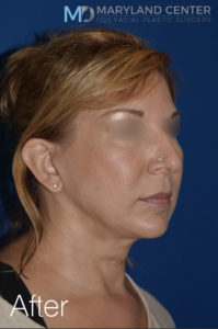 Facelift/Necklift Before and After Pictures Baltimore, MD