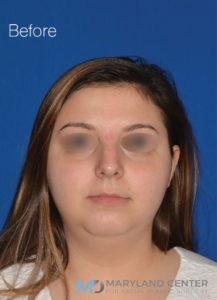 Facial Liposuction Before photo