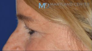 Blepharoplasty Before and after photo