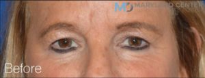 Blepharoplasty Before and after photo