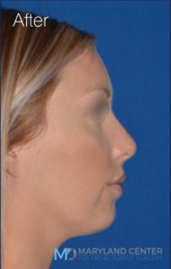Non surgical nose job before and after photos in Baltimore MD