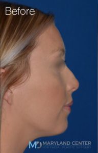 Non surgical nose job before and after photos in Baltimore MD