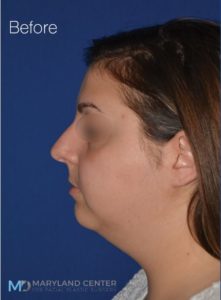 Facial Liposuction Before photo