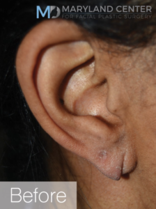 earlobe repair before