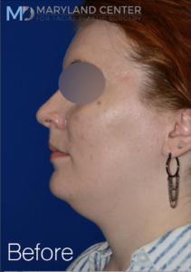 facial liposuction case 4 before