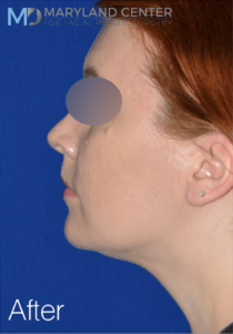 facial liposuction case 4 after