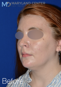 facial liposuction case 4 before