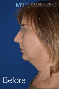 Facelift/Necklift Before and After Pictures Baltimore, MD