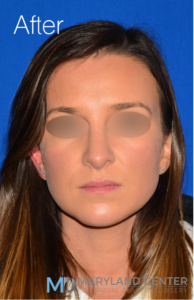 Rhinoplasty Case 12 Front After
