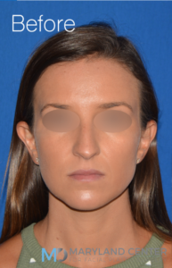 Rhinoplasty Case 12 Front Before